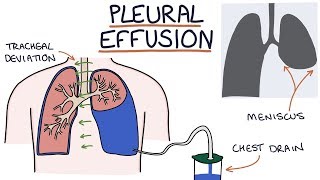 Chest Radiography Pulmonary Edema [upl. by Ydissak505]