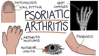 Psoriatic Arthritis [upl. by Malissa434]