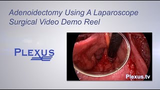 Adenoidectomy Surgical Video [upl. by Anem]