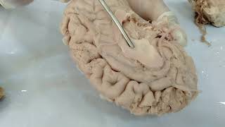 Basal Ganglia of Brain  Neuroanatomy [upl. by Hereld978]