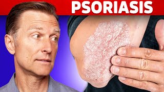 Psoriasis Scalp Scratching Huge Flakes 718 [upl. by Rollo]