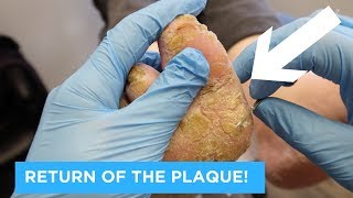 RETURN OF THE PLAQUE  PSORIATIC PLAQUE PART 2 [upl. by Noram]