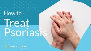 Psoriasis Treatment  Explained by Dermatologist [upl. by Harifaz]