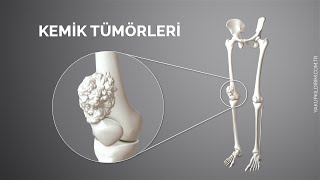 Kemik Tümörleri  Prof Dr Yakup YILDIRIM [upl. by Haeckel]