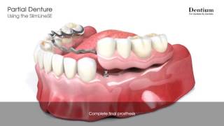 Partial denture  SlimLineSE [upl. by Yoko]