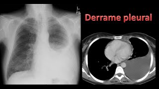 Derrame pleural [upl. by Ecirtnahs]