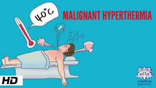 MALIGNANT HYPERTHERMIA Causes Signs and Symptoms Diagnosis and Treatment [upl. by Healion]