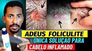 Cabelo Inflamado O Melhor Remédio Para Acabar Com a Foliculite no Couro Cabeludo [upl. by Bunker513]