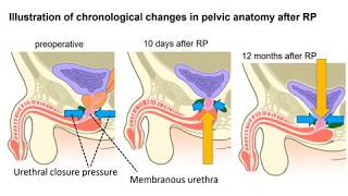 Urinary continence recovery after radical prostatectomy [upl. by Grange]