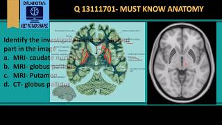 MRI Brain anatomy  Basal ganglia [upl. by Cornwall]