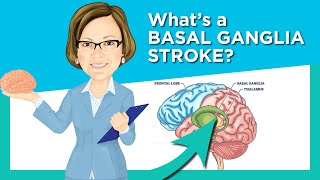 Basal Ganglia Stroke [upl. by Lednem]